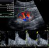 Color Doppler ultrasound image showing systolic and diastolic blood flow velocities and resistive index in a normal kidney.