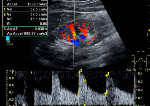 Color Doppler ultrasound image showing systolic and diastolic blood flow velocities and resistive index in a normal kidney.