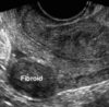 Ultrasound scan of uterus showing fibroids detection in a diagnostic clinic