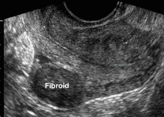 Ultrasound scan of uterus showing fibroids detection in a diagnostic clinic