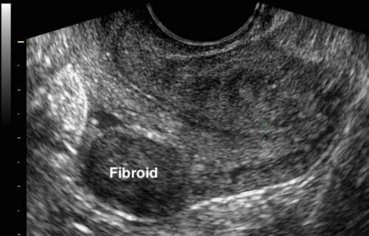 Ultrasound scan of uterus showing fibroids detection in a diagnostic clinic