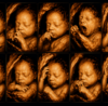 Pregnant woman in her third trimester undergoing a fetal growth scan with Doppler ultrasound while reviewing her baby's development. The image highlights the importance of serial growth monitoring, placental assessment, and fetal well-being evaluation during late pregnancy.